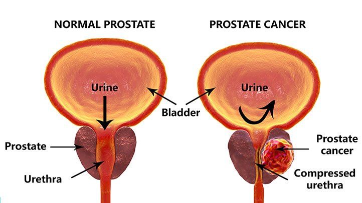 प्रोस्टेट कैंसर का एक हफ्ते में होगा इलाज