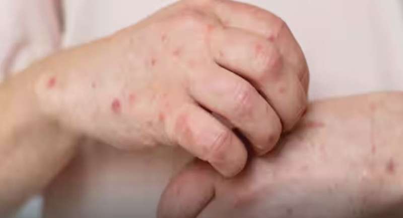 मंकीपॉक्स का कहर: केरल में दूसरा केस मिलने पर केंद्र ने जारी की एडवाइजरी