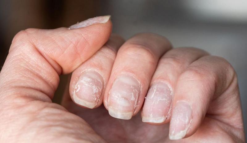 नाखून हमारे शरीर की आंतरिक सेहत का संकेत : आयुर्वेद