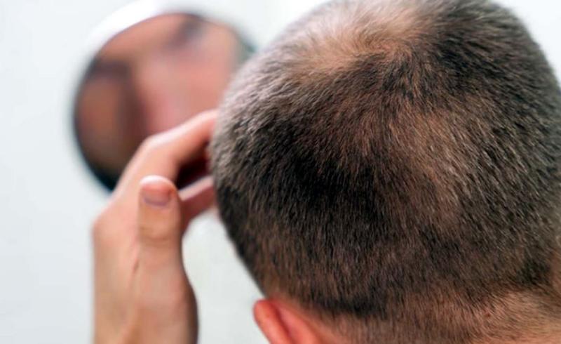 गंजेपन की समस्या से निजात दिलाने लाया गया……………हेयर ग्रोथ सीरम