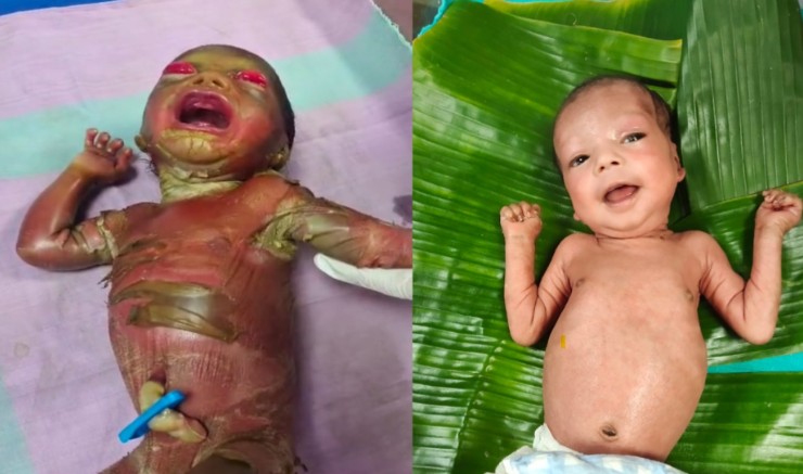 सुदूर बीजापुर में चिकित्सा चमत्कार : अत्यंत दुर्लभ बीमारी से जूझते शिशु को बचाया