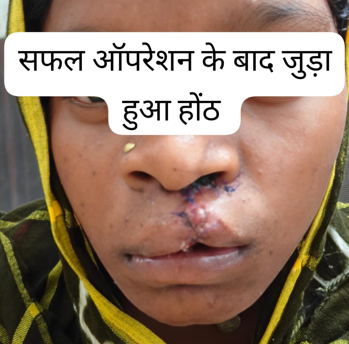 सफल सर्जरी से भीमे हेमला के चेहरे पर लौटी मुस्कान